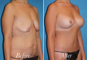 Breast Lift With Augmentation Before and After Patient Thumbnail 3