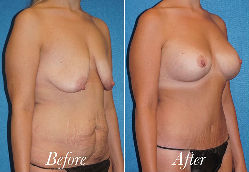 Breast Lift With Augmentation Before and After Patient 3