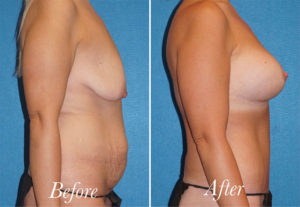 Breast Lift With Augmentation Before and After Patient Thumbnail 4