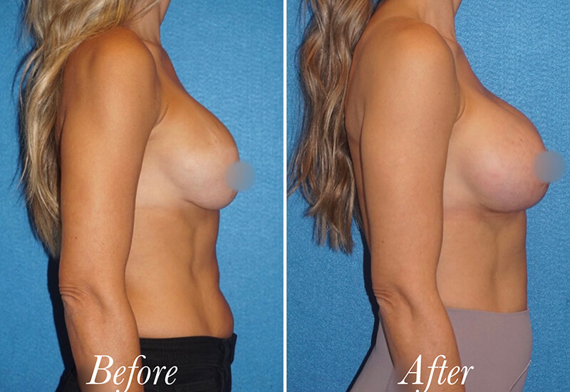Breast Lift With Augmentation Before and After Patient 2