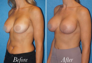 Breast Lift With Augmentation Before and After Patient Thumbnail 3