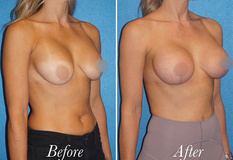Breast Lift With Augmentation Before and After Patient 5
