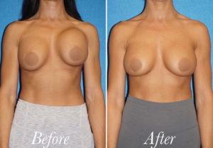 Breast Augmentation Revision Before and After Patient Thumbnail 1