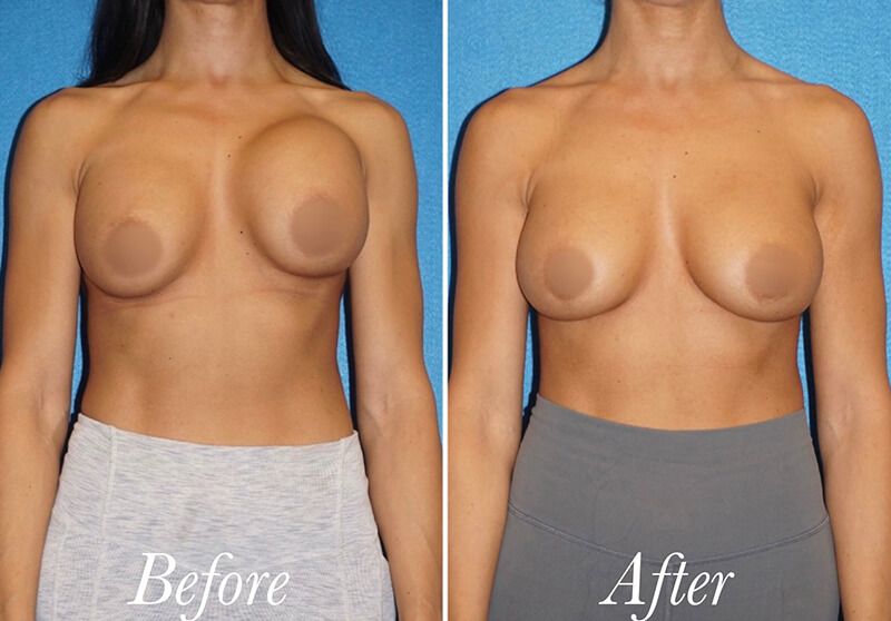 Breast Augmentation Revision Before and After Patient 1
