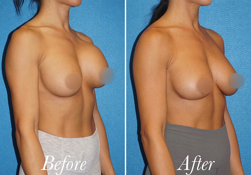 Breast Augmentation Revision Before and After Patient 3