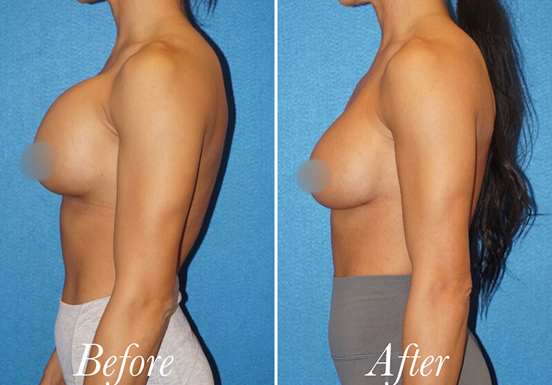 Breast Augmentation Revision Before and After Patient 4