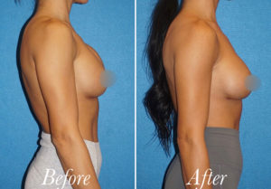 Breast Augmentation Revision Before and After Patient Thumbnail 5