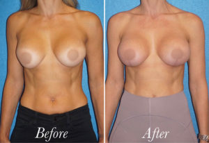 Breast Augmentation Revision Before and After Patient Thumbnail 1