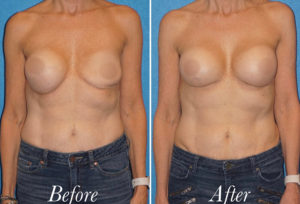 Breast Augmentation Revision Before and After Patient Thumbnail 1
