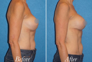 Breast Augmentation Revision Before and After Patient Thumbnail 2