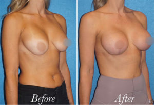 Breast Augmentation Revision Before and After Patient Thumbnail 3