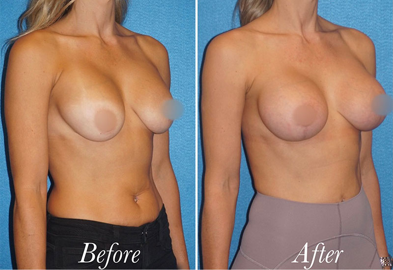 Breast Augmentation Revision Before and After Patient 3
