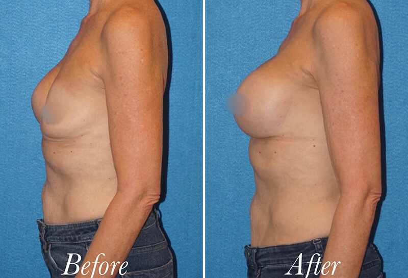Breast Augmentation Revision Before and After Patient 3