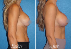 Breast Augmentation Revision Before and After Patient Thumbnail 4
