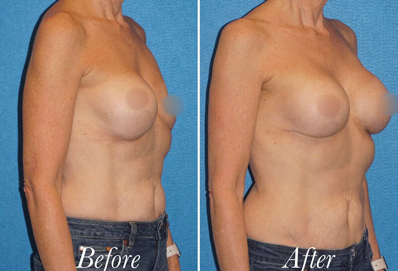Breast Augmentation Revision Before and After Patient 4