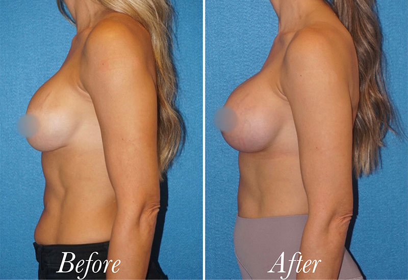Breast Augmentation Revision Before and After Patient 5