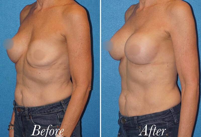 Breast Augmentation Revision Before and After Patient 5