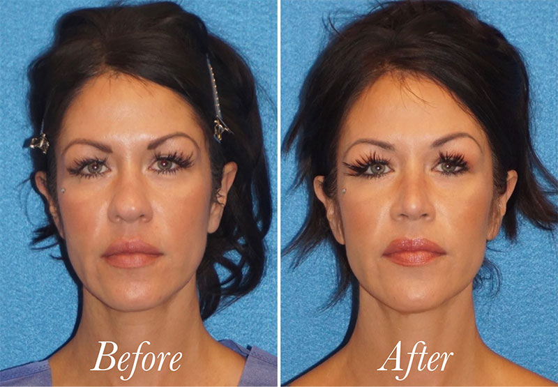 Face Before and After Patient 1