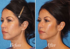 Face Before and After Patient Thumbnail 3