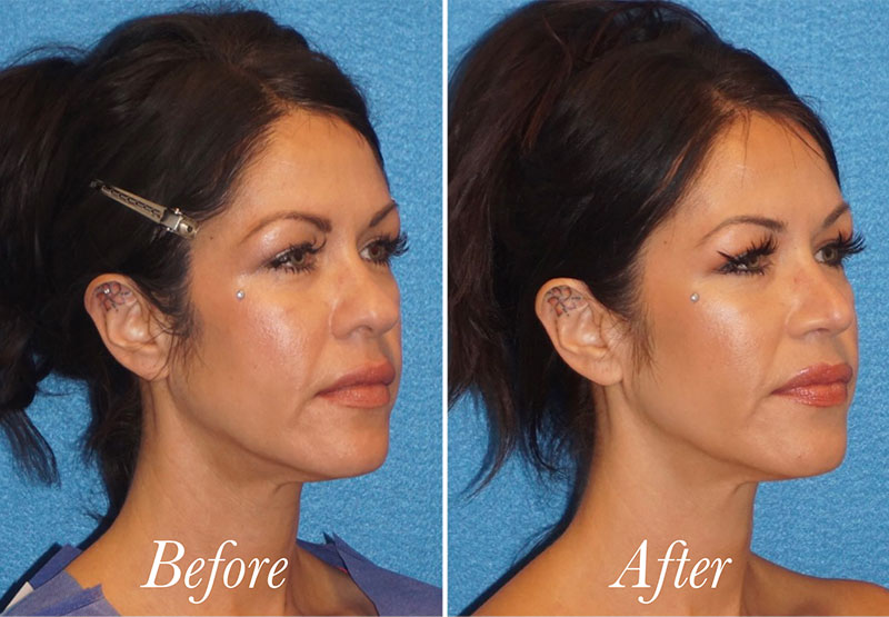 Face Before and After Patient 2