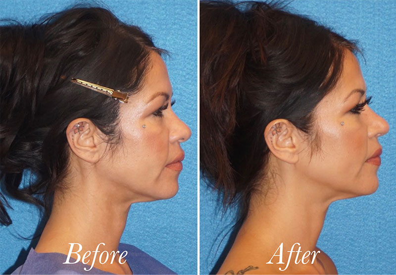 Face Before and After Patient 5