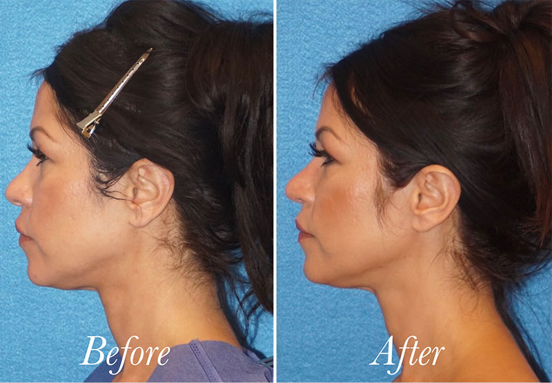 Face Before and After Patient 4