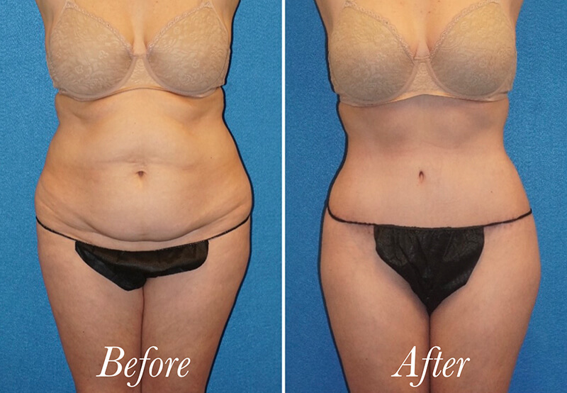 Body Before and After Patient 1