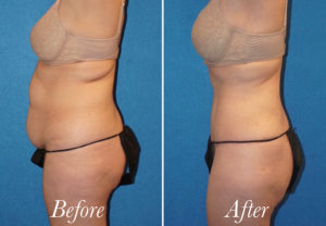 Body Before and After Patient Thumbnail 2