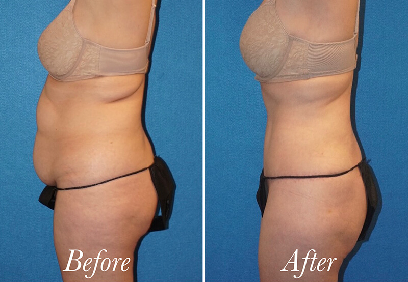 Body Before and After Patient 2