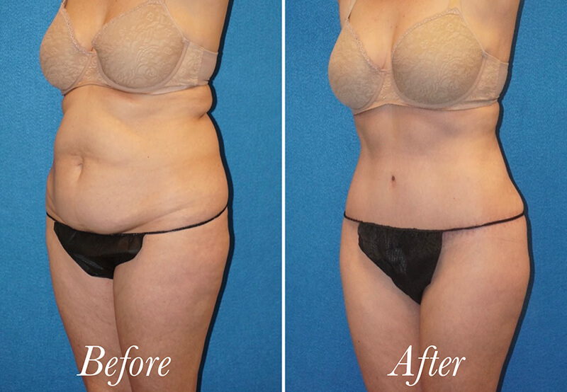 Body Before and After Patient 3