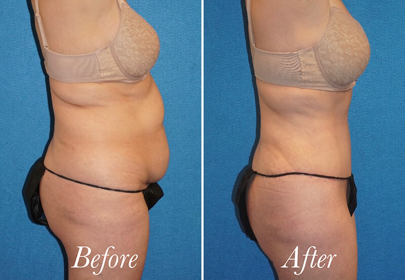 Body Before and After Patient 4