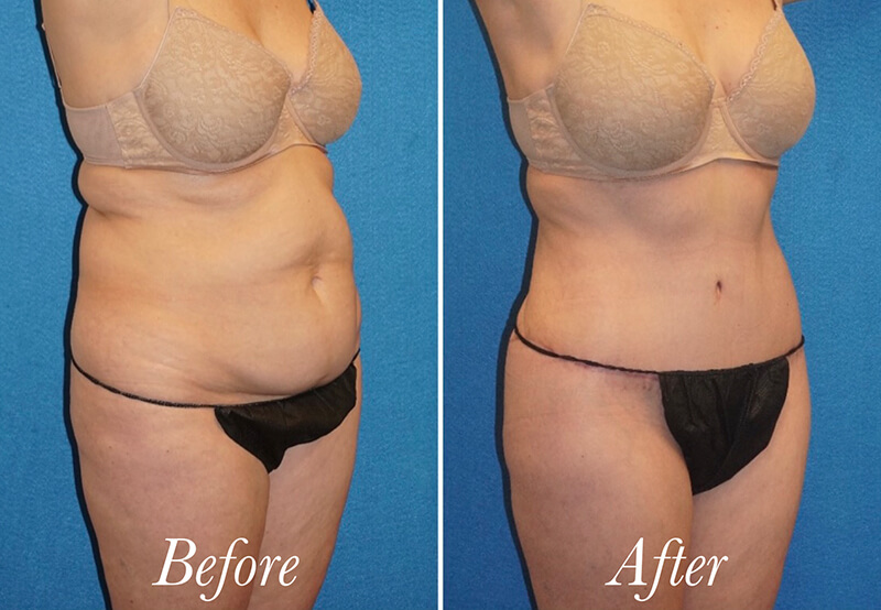 Body Before and After Patient 5