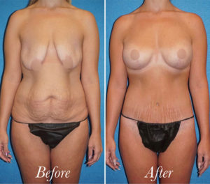 Body Before and After Patient Thumbnail 1