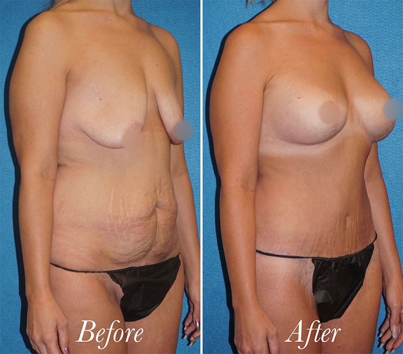 Body Before and After Patient 3