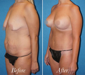 Body Before and After Patient Thumbnail 2