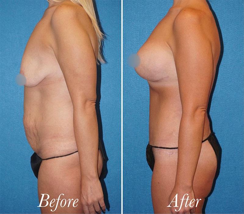 Body Before and After Patient 5