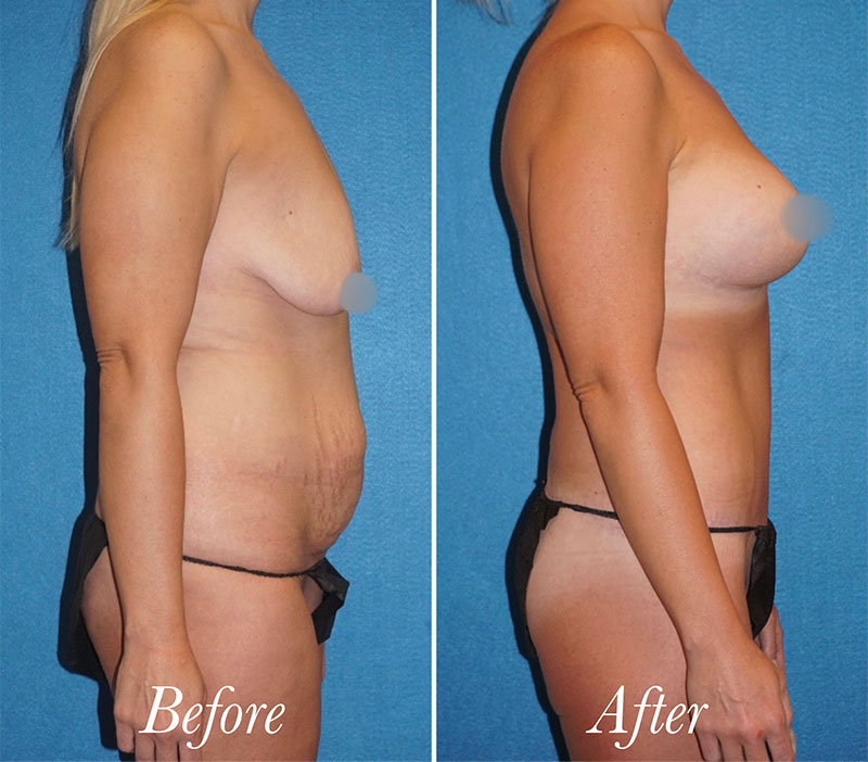 Body Before and After Patient 4