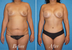 Body Before and After Patient Thumbnail 1