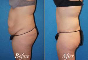 Body Before and After Patient Thumbnail 4