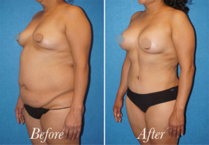 Body Before and After Patient Thumbnail 2