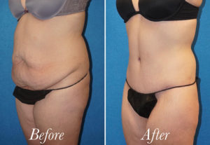 Body Before and After Patient Thumbnail 2