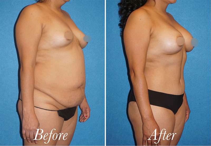 Body Before and After Patient 3