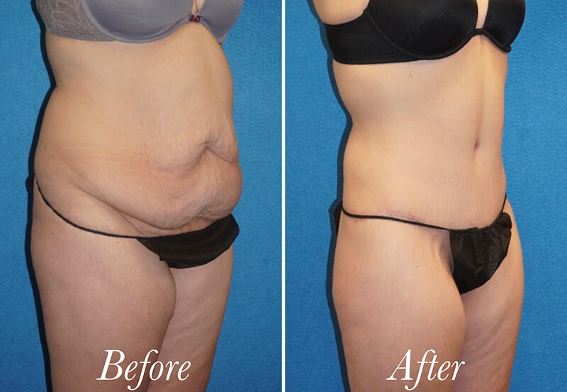 Body Before and After Patient 3