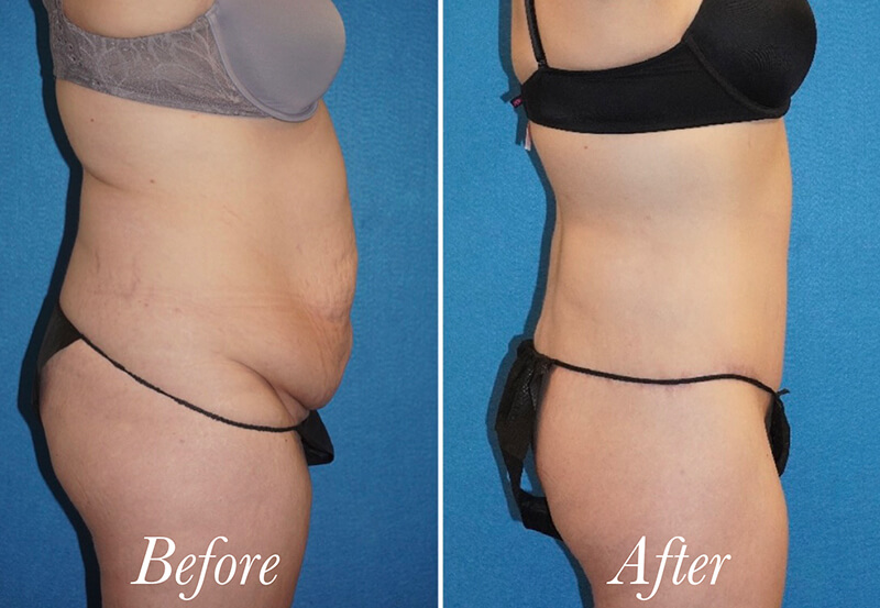 Body Before and After Patient 5