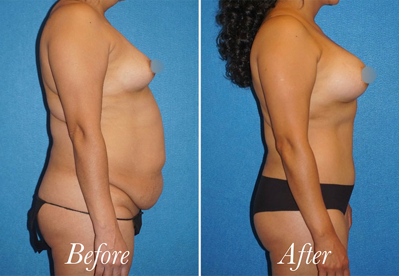 Body Before and After Patient 5