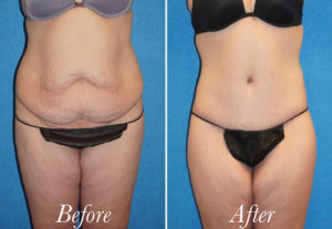 Body Before and After Patient Thumbnail 1