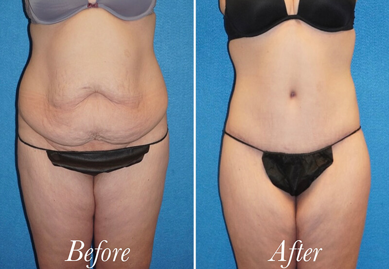 Body Before and After Patient 1