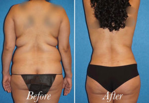 Body Before and After Patient Thumbnail 6