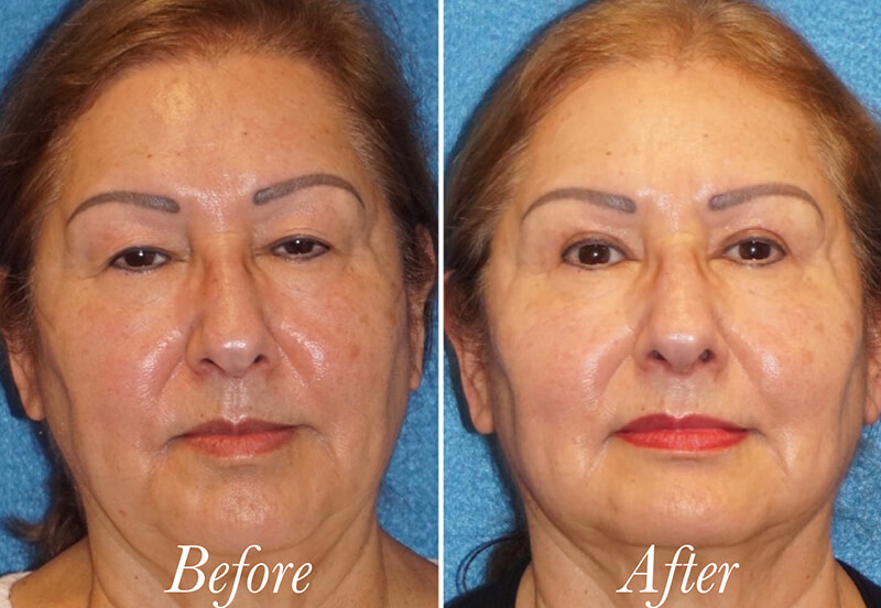 Face Before and After Patient 1