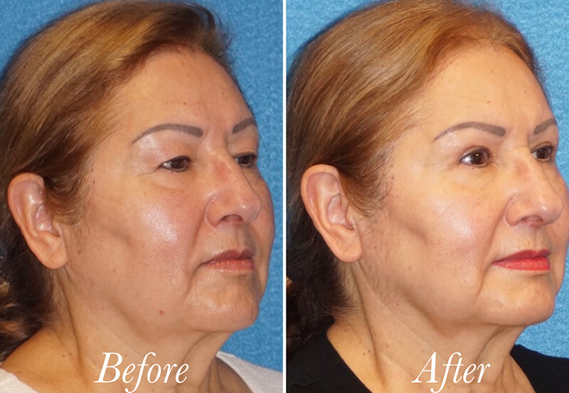 Face Before and After Patient 2